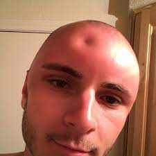 smiling person with a bald forehead, who looks like someone's just squished their forehead by poking it with a finger